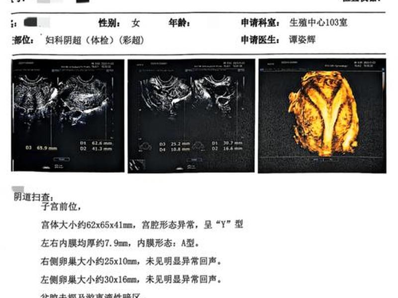amh是做b超吗(amh检查是b超还是抽血) amh是做b超吗(amh检查是b超还是抽血)