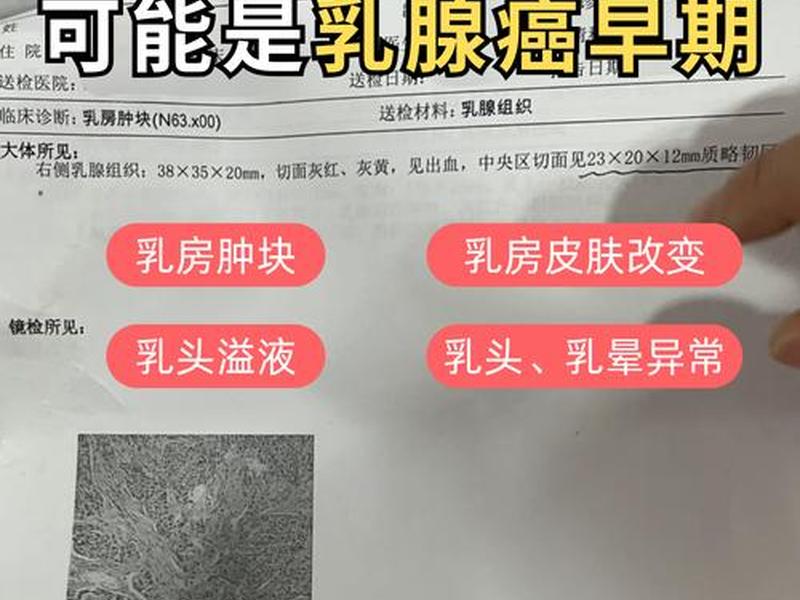 idc是什么、idc是什么乳腺癌 idc是什么、idc是什么乳腺癌