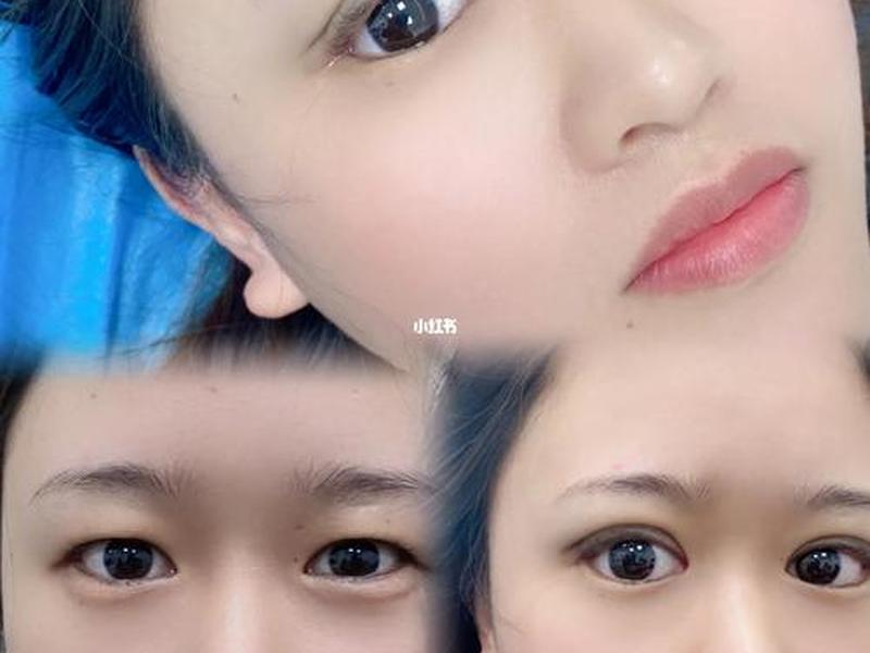 柠檬爱美纳米无痕双眼皮 纳米无痕双眼皮操作过程视频 柠檬爱美纳米无痕双眼皮 纳米无痕双眼皮操作过程视频