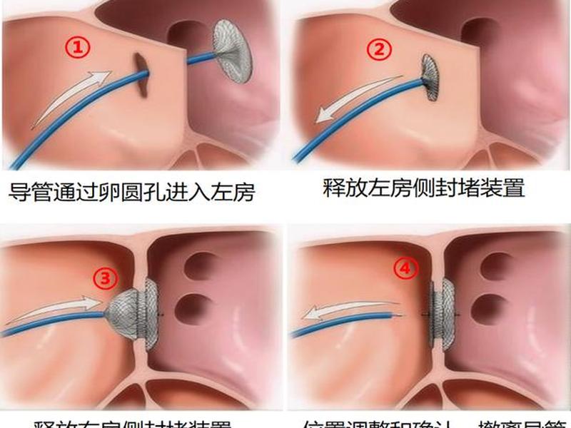 一站式手术、一站式手术为什么先消融后封堵 一站式手术、一站式手术为什么先消融后封堵